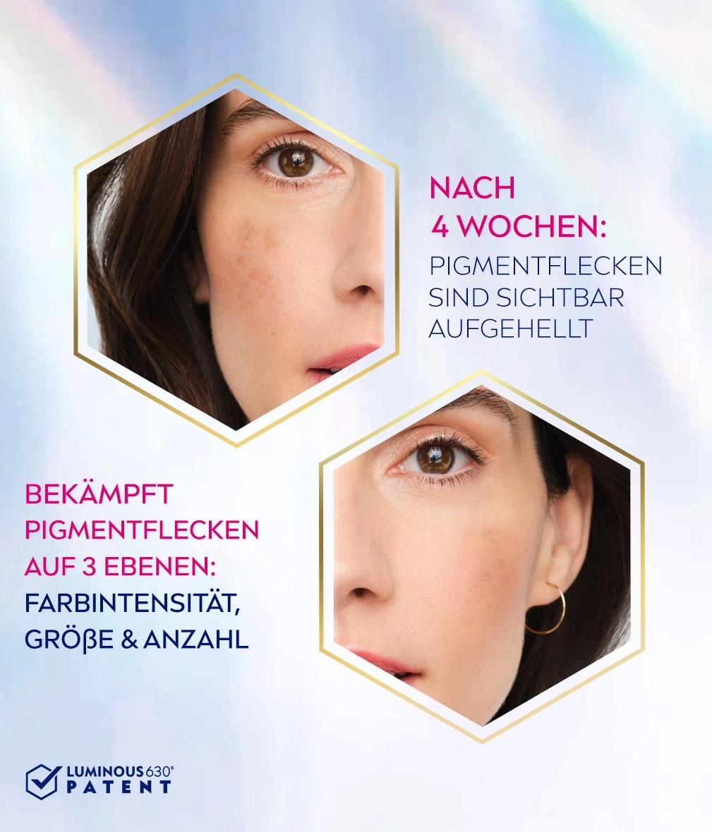 Gesicht mit Pigmentflecken, Text über Hautaufhellung nach 4 Wochen.