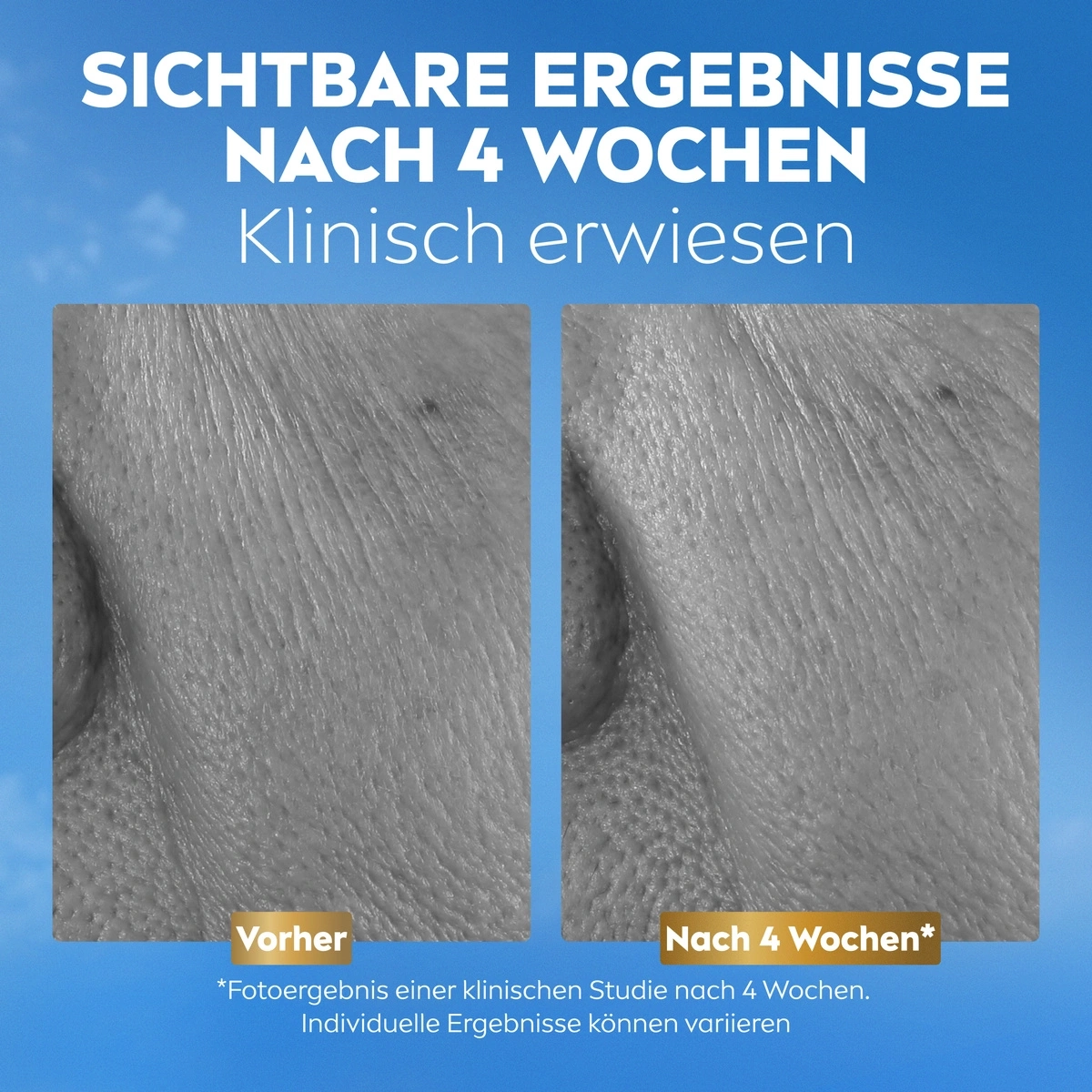 Vorher-Nachher-Vergleich von Hautfalten nach vier Wochen klinisch erwiesen